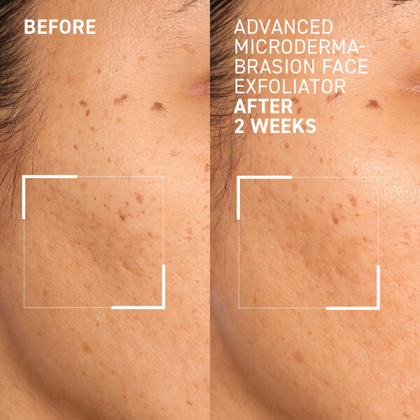 Advanced Microdermabrasion Face Exfoliator (Bild 3 von 4)