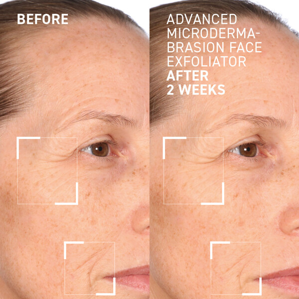 Advanced Microdermabrasion Face Exfoliator (Bild 4 von 4)